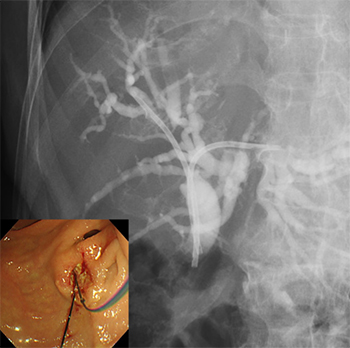 悪性肝門部胆管狭窄に対する内視鏡的インサイドステント留置術