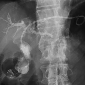 悪性遠位胆管狭窄に対する超音波内視鏡下肝内胆管胃吻合術(EUS-HGS)
