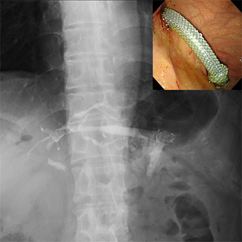 悪性遠位胆管狭窄に対する超音波内視鏡下肝内胆管胃吻合術(EUS-HGS)